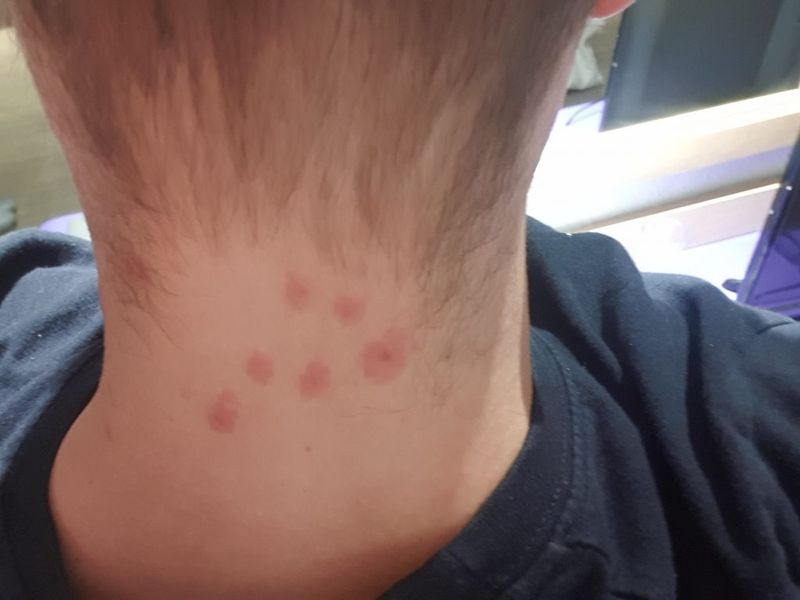 Clusters of Itchy Red Welts on Your Skin